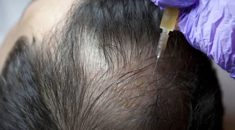 PRP hair treatment cost in India